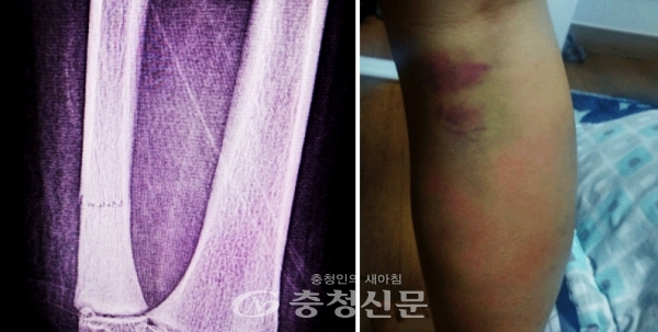 코치의 폭행해 팔 골절된 사진과 다리 (사진 = 피해학부모 제공)